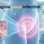 Vaginal yeast infection